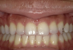 Dr. Nasir General Dentistry | ZOOM  Whitening, Ceramic Crowns and Sedation Dentistry